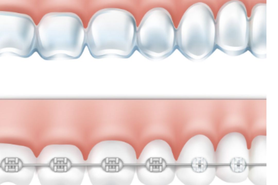  affordable aligners vs braces cost, comfort, 